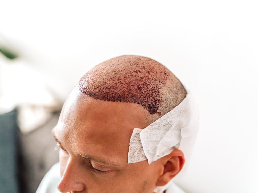 after-hair-transplantation-surgical-technique-that-2024-12-01-09-27-36-utc